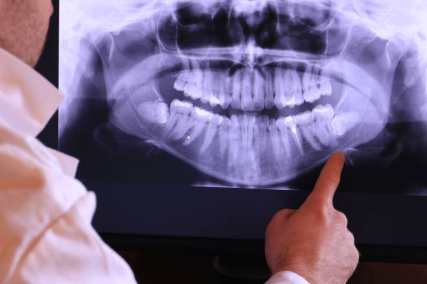 Best Emergency Tooth Extraction in Mango, FL