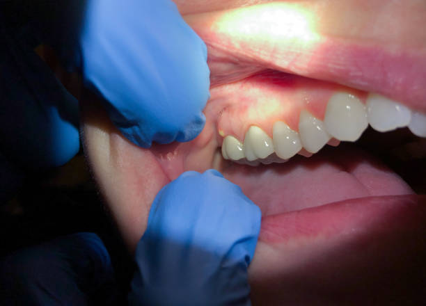 Best Emergency Tooth Extraction in Mango, FL